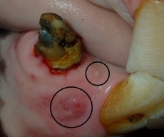 Nonvital (dead, infected) right lower canine tooth due to tooth resorption
