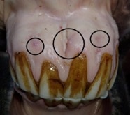 Uneven, receding gumlines with subgingival swelling and draining tracts