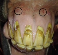 Uneven, receding gumlines with subgingival swelling, draining tracts
