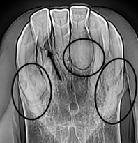 All upper incisors affected with both areas of hypercementosis